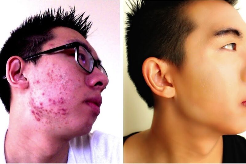 Eradicating Acne Scars: A Man’s Guide to Smoother, Clearer Skin